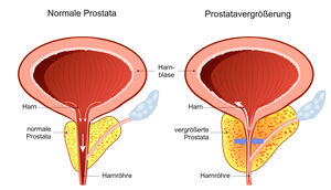 Prostata